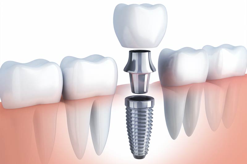 Implants Dentist in Concord