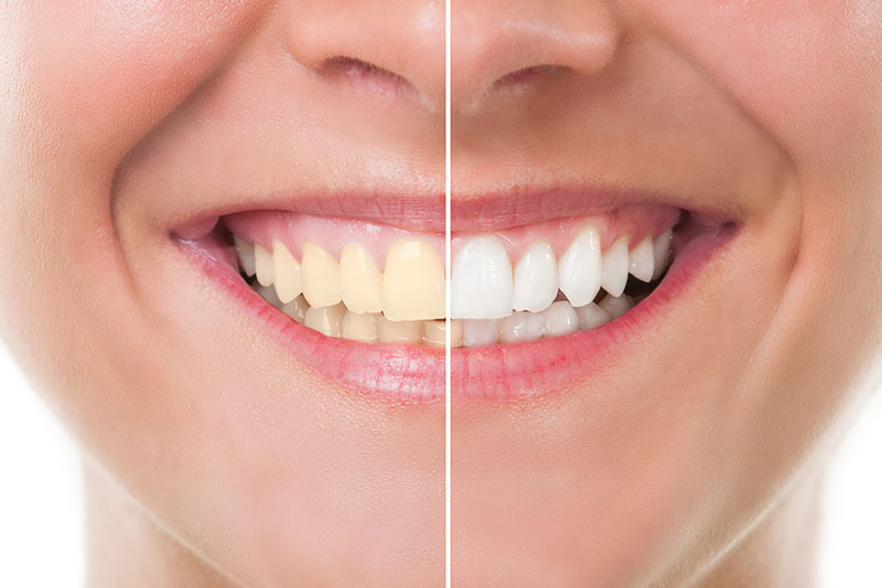 Teeth Whitening in Concord